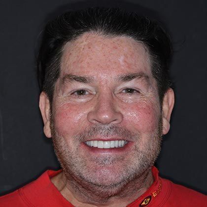 Full Mouth Rehabilitation Edward - After