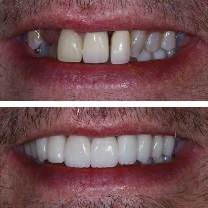 Full Mouth Rehabilitation Edward - Before