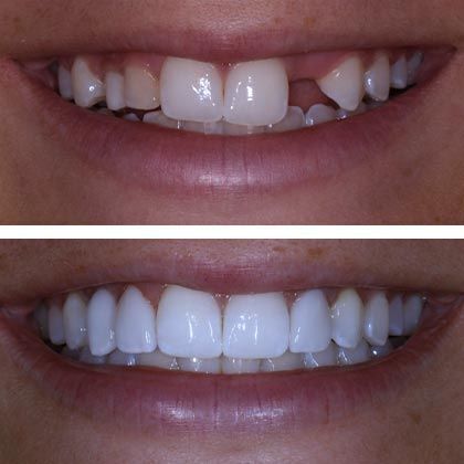 Dental Implants Nicole - Before