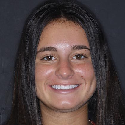 Dental Implants Nicole - After