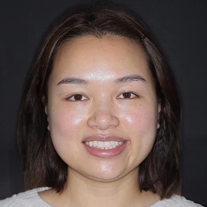 Dental Implants Yi - After