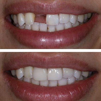 Dental Implants Yi - Before