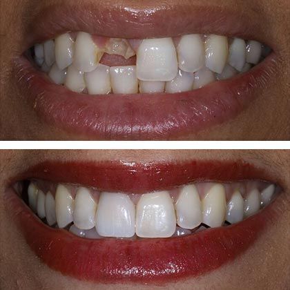 Dental Implants Galit - Before