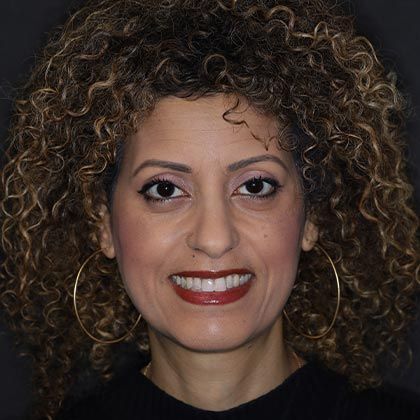 Dental Implants Galit - After