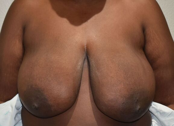 Breast Lift (Mastopexy) Case 203 - Before