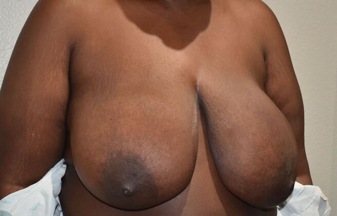Breast Lift (Mastopexy): Case 203 - Before