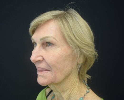 Laser Resurfacing: Case 1 - After