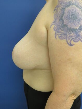 Breast Reduction/ Breast Lift: Case 16 - After