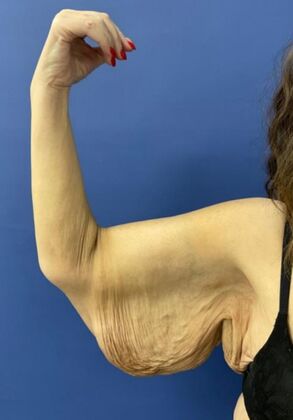 Arm Lift Case 4 - Before