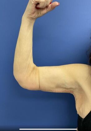 Arm Lift Case 4 - After