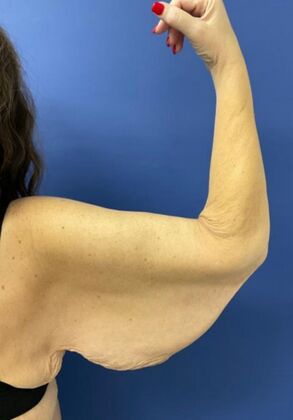 Arm Lift: Case 4 - Before