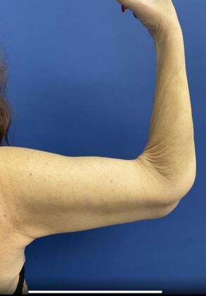 Arm Lift: Case 4 - After