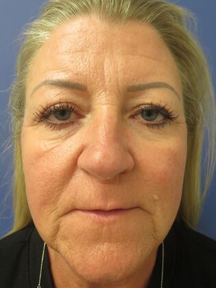 Brow Lift Case 7 - Before