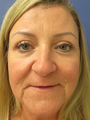 Brow Lift Case 7 - After