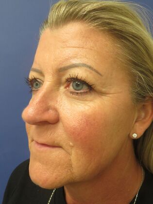 Brow Lift: Case 7 - Before