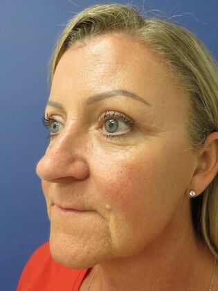 Brow Lift: Case 7 - After
