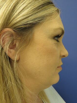 Facelift / RestoreLift Case 24 - Before