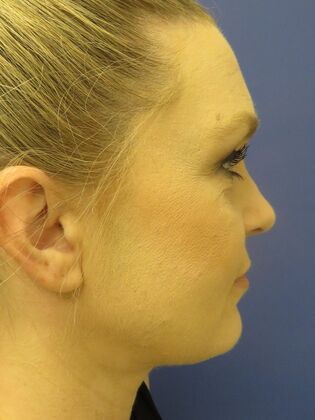 Facelift / RestoreLift Case 24 - After