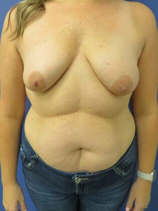 Breast Reduction/ Breast Lift Case 17 - Before