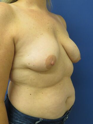 Breast Reduction/ Breast Lift: Case 17 - Before