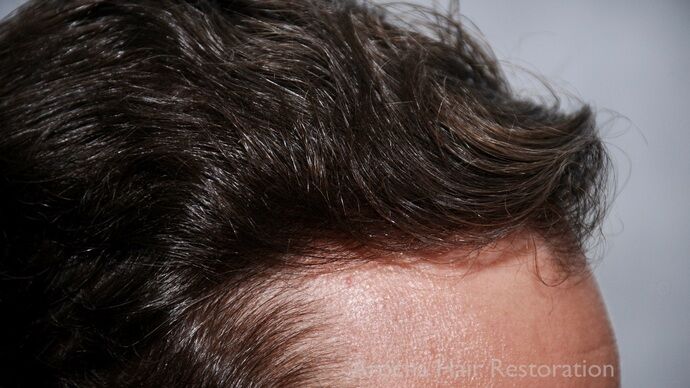 FUT Hair Restoration: Case 42 - After