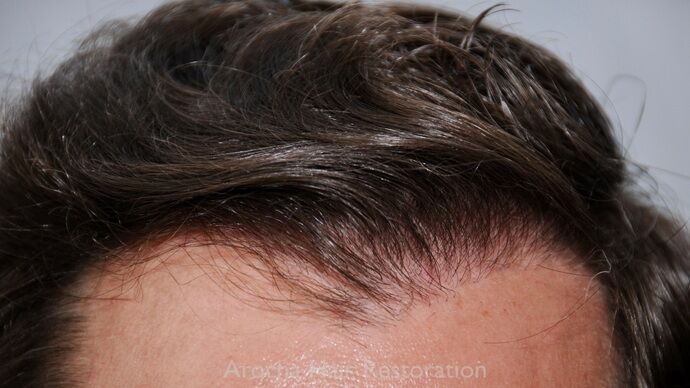 FUT Hair Restoration: Case 42 - After