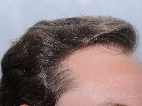 FUT Hair Restoration: Case 42 - After