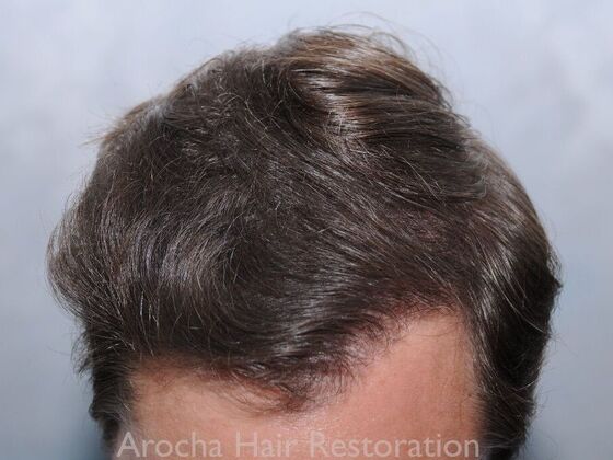 FUT Hair Restoration Case 42 - After