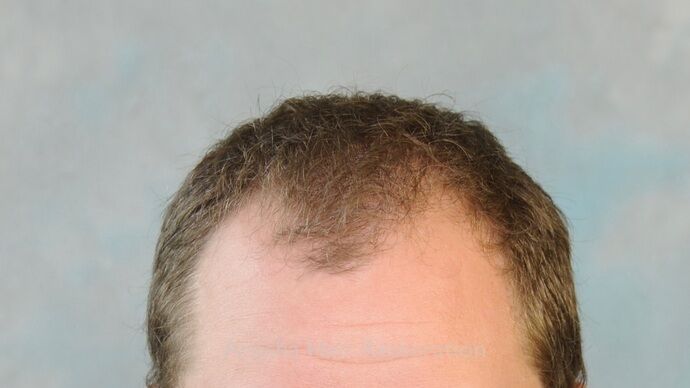 FUT Hair Restoration: Case 42 - Before