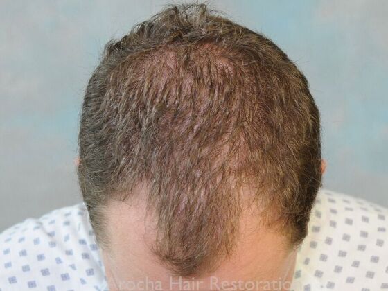 FUT Hair Restoration Case 42 - Before