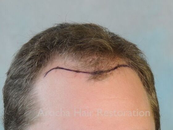 FUT Hair Restoration: Case 42 - Before