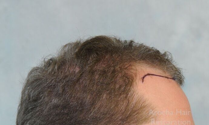 FUT Hair Restoration: Case 42 - Before