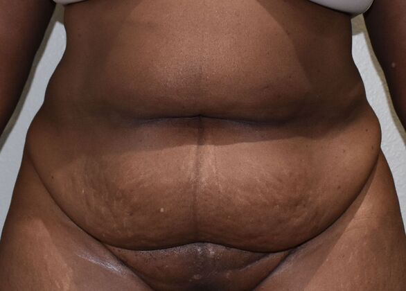 Tummy Tuck (Abdominoplasty): Case 482 - Before