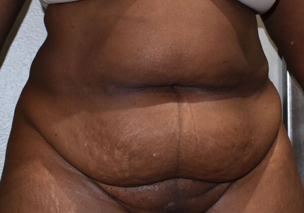 Tummy Tuck (Abdominoplasty): Case 482 - Before