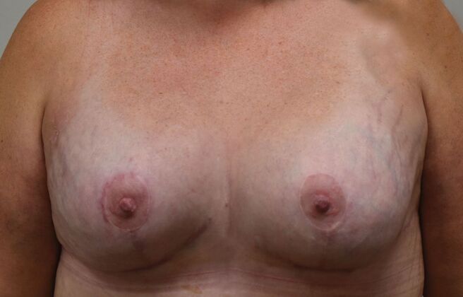 Breast Augmentation w/ Lift: Case 534 - After