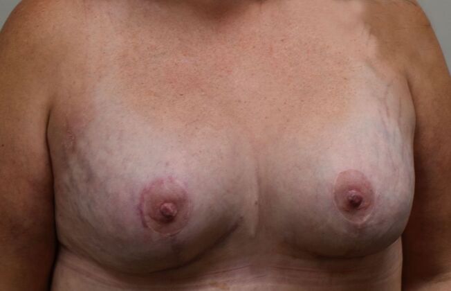 Massive Weight Loss : Case 151 - After