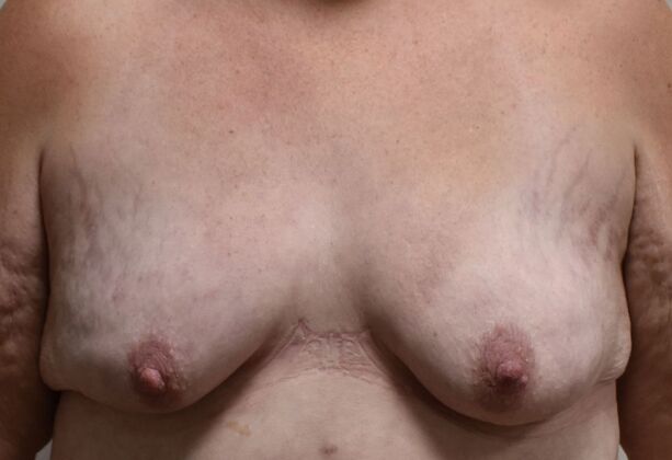 Massive Weight Loss : Case 151 - Before