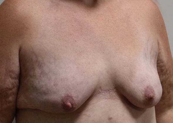 Massive Weight Loss : Case 151 - Before