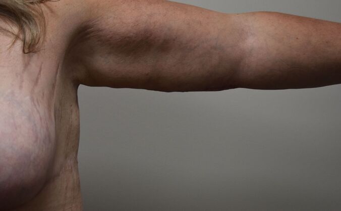 Brachioplasty Case 21 - After