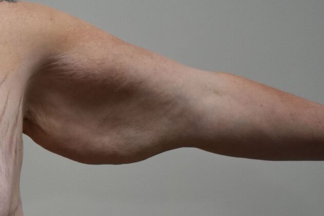 Brachioplasty Case 21 - Before