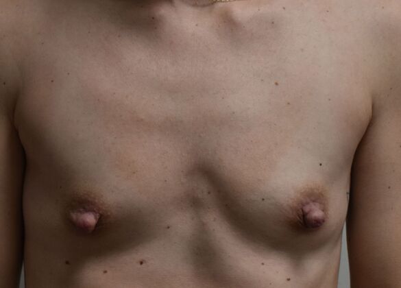 Breast Augmentation Case 116 - Before
