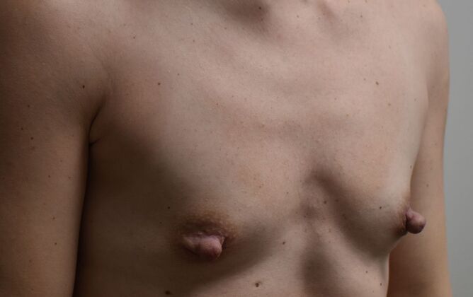 Breast Augmentation: Case 116 - Before