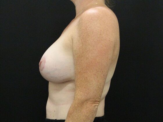 Breast Revision: Case 8 - After