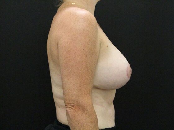 Breast Lift & Breast Lift Augmentation: Case 30 - After