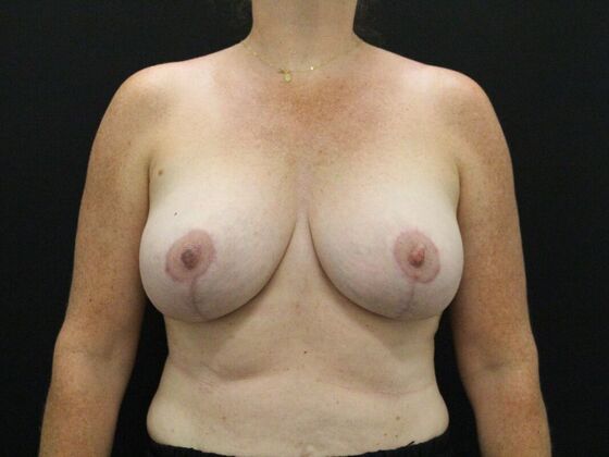 Breast Lift & Breast Lift Augmentation Case 30 - After