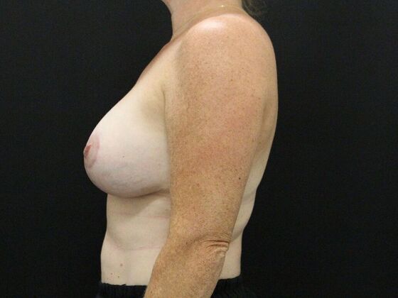 Breast Lift & Breast Lift Augmentation: Case 30 - After