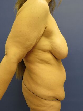 Mommy Makeover: Case 17 - Before