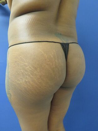 Brazilian Butt Lift Case 10 - Before