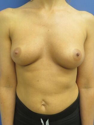Breast Augmentation Case 46 - Before
