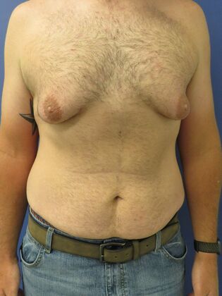 Gynecomastia Surgery (Male Breast Reduction Surgery) Case 16 - Before